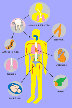 歯周病が起因する全身の病気