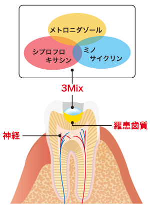 3Mix法