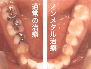 ノンメタル治療