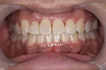 インビザライン治療後