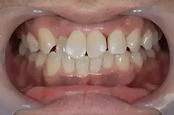 インビザライン治療前