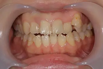 インビザライン治療前