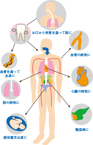 歯周病 歯槽膿漏 明石アップル歯科