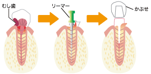 根の病気と治療 根の病気と治療