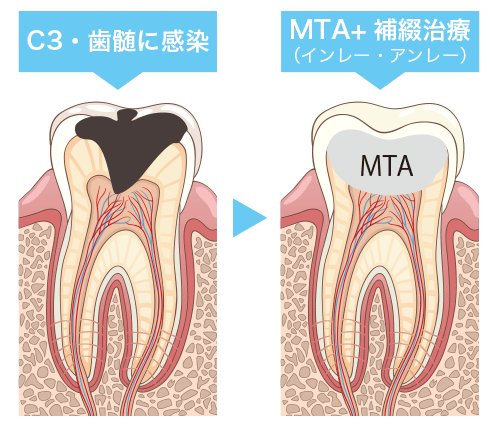 神経を守るMTAセメント覆髄治療（歯髄保存治療）