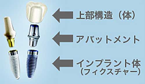 インプラントとは
