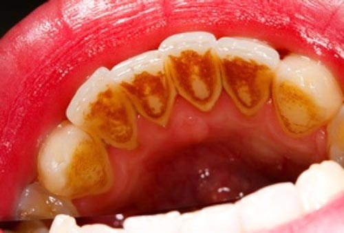 次世代タバコに変えれば歯周病は良くなるの 明石アップル歯科