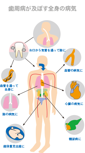 長年の頭痛 糖尿病 脳梗塞の原因は なんと 歯 明石アップル歯科