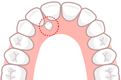 過剰歯イラスト