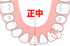 先天性欠如歯イラスト