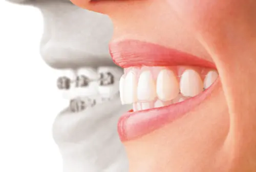 インビザラインとワイヤー矯正の装着時の違い