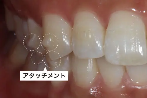 アタッチメント