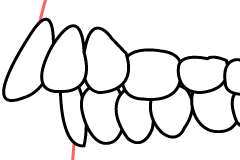 上顎前突の線画