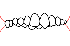 過蓋咬合の線画