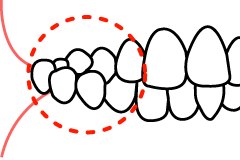 交叉咬合の線画