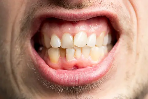 悪い歯並びのイメージ