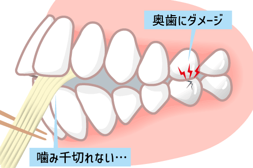 面が噛み切れないイラスト