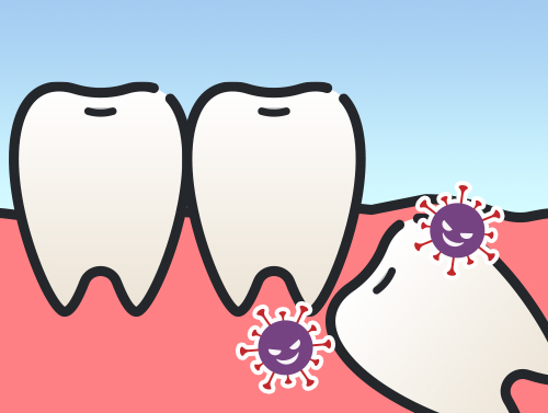 歯肉に埋まって菌に感染する親知らず