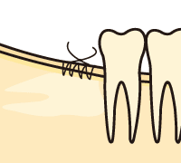 抜歯窩の縫合