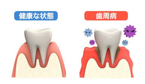 健康な歯茎と歯周病の歯茎