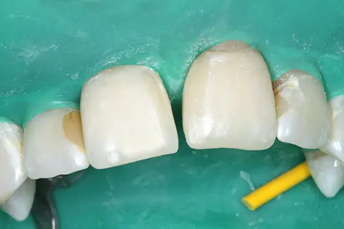 レジン治療前の歯
