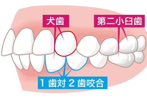 一歯対二歯咬合