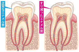 知覚過敏の仕組み