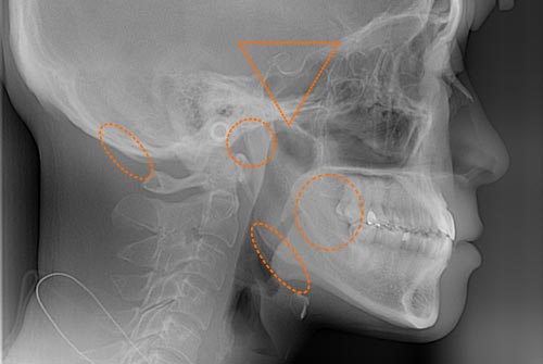 顎関節症で影響が出やすい部位のレントゲン