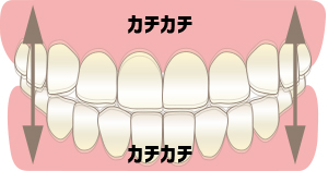 タッピングタイプのイラスト