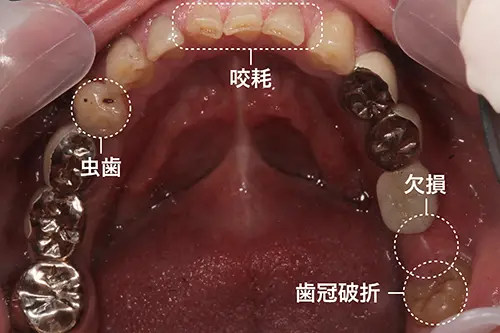 歯ぎしりによって悪くなった口腔内の写真