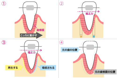 矯正で歯が動く仕組み