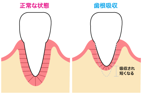 歯根吸収