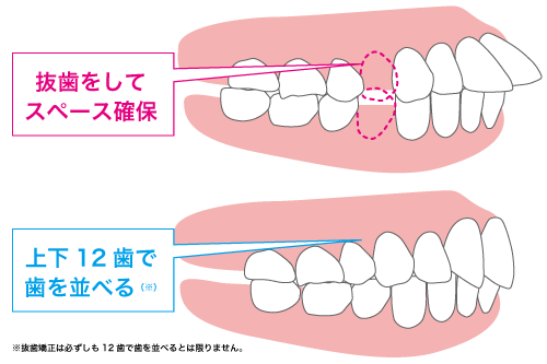 抜歯矯正