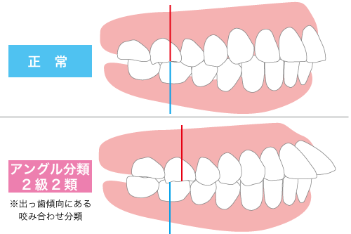 アングル分類