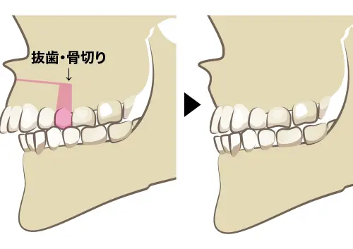 外科矯正