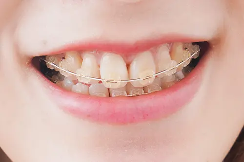 ワイヤー矯正の模型