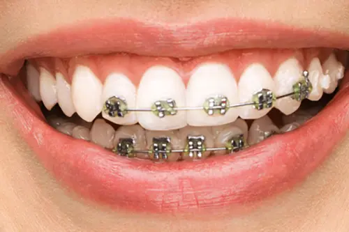 部分矯正のモデル