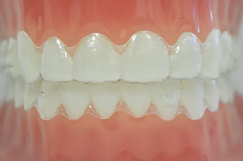 マウスピース矯正の装着