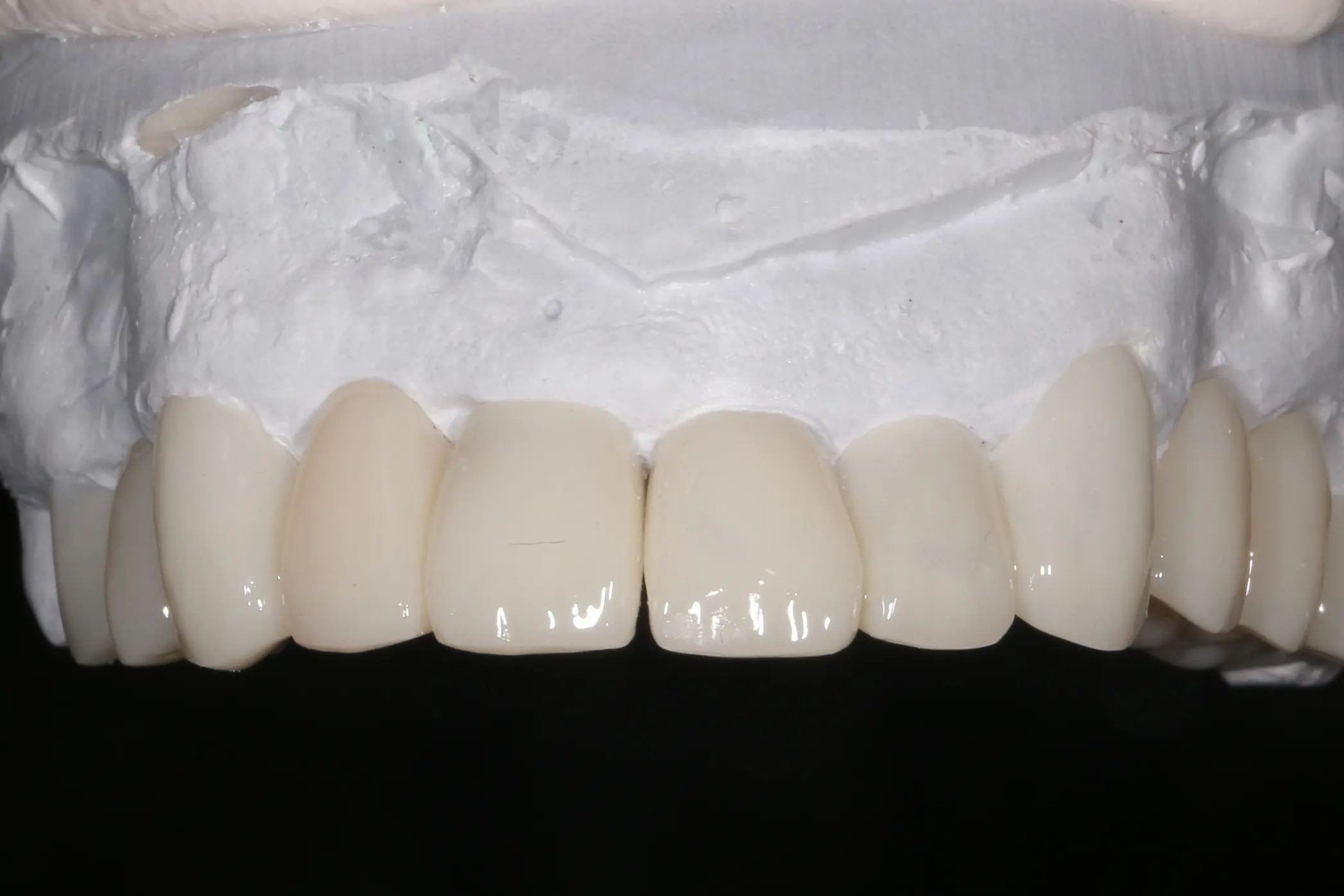 セラミック治療の模型