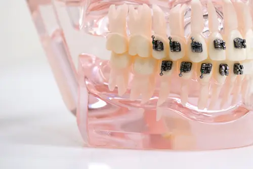 部分矯正の模型