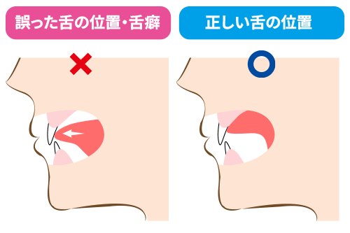 舌の正しい位置と舌突出癖の対比イラスト