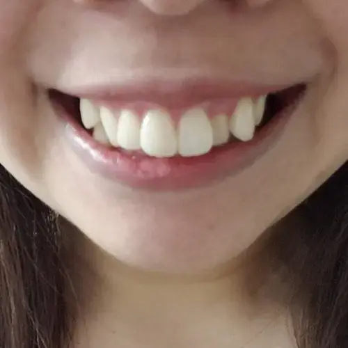 八重歯の悩みイメージ