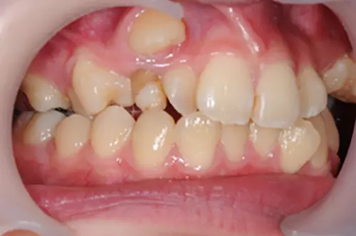 難症例の八重歯のイメージ