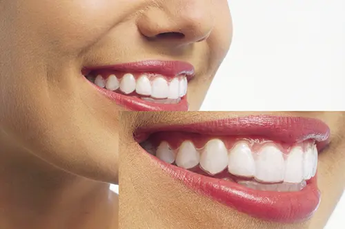 目立たない矯正装置