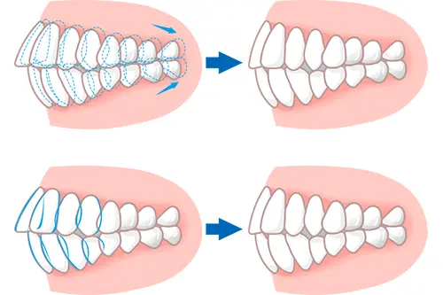 歯のスペースの作り方
