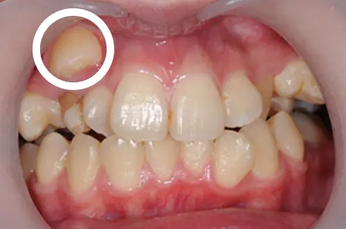 高い位置に生えた八重歯