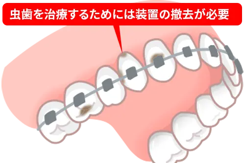 矯正中に虫歯や歯周病が発生し治療を中断するイメージ