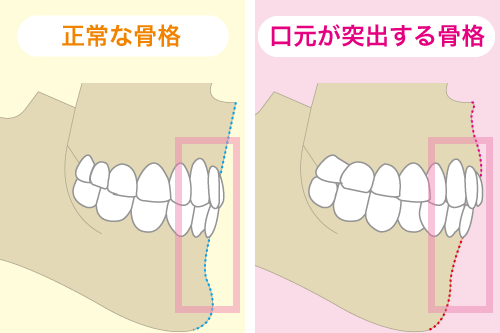 口元が突出する骨格のイラスト