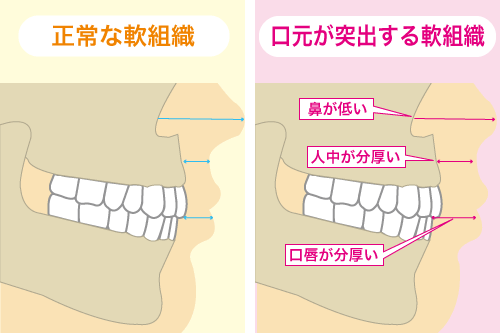 口元が突出する軟組織のイラスト