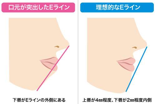 口元が突出したEラインと理想的なEライン